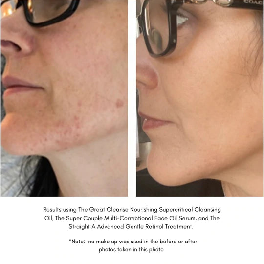 The Straight A | Advanced Gentle Retinol Treatment